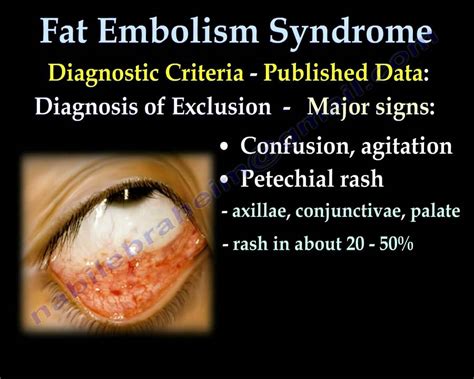 Fat Embolism Syndrome - Everything You Need To Know - Dr. Nabil ...