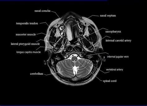 MRI neck anatomy | free MRI axial neck cross sectional anatomy ...