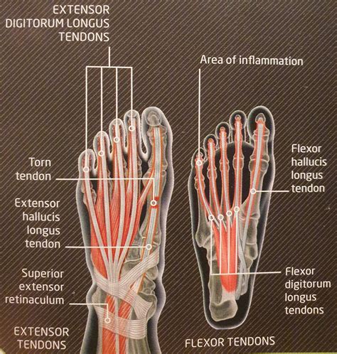 tendon injuries in foot and ankle - Massage Kildare Naas Portlaoise