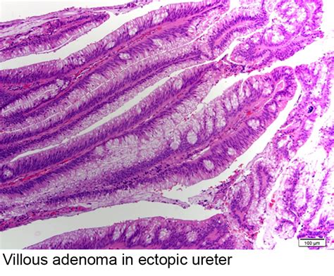 Pathology Outlines - Villous adenoma