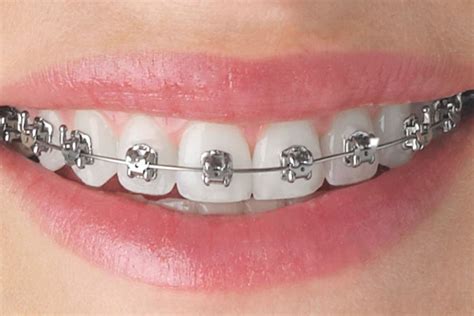 Metallic Braces - Teeth & Braces Clinic - Indore