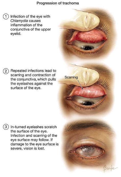 Trachoma | Eye anatomy, Eye facts, Eye health