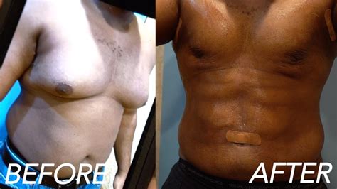 Gynecomastia Surgery 3 Days Post-Op - YouTube