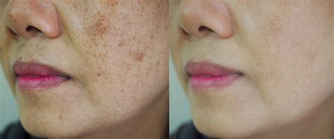 Melasma Treatment Brisbane | Skin Confidence Clinic