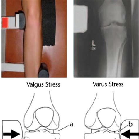 Setup for varus stress radiograph on left lower extremity, with... | Download Scientific Diagram