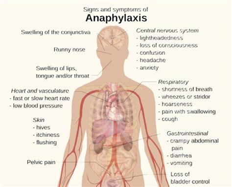 Anaphylactic shock | News | Dentagama