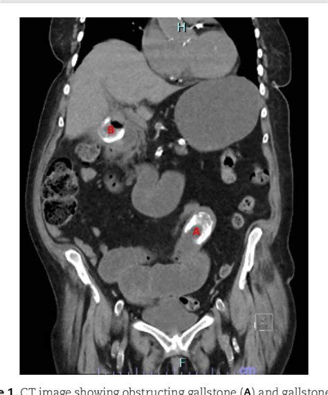 Figure 1 from A case of recurrent gallstone ileus within 1 week post enterolithotomy | Semantic ...