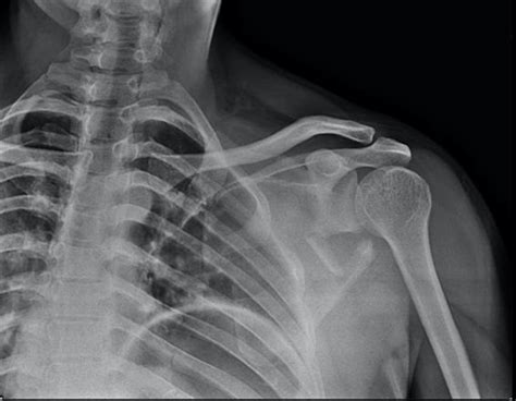 Scapula Fractures – Core EM