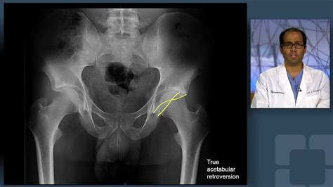 Global Acetabular Retroversion - YouTube