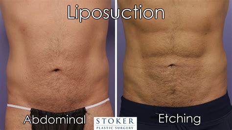 Liposuction Los Angeles: Top Plastic Surgeon Dr. Stoker Discusses Keys to Abdominal Etching ...