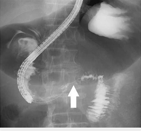 Figure 3 from The Malignant Obstruction Caused by Pancreatic Cancer Within the Uncinate Process ...