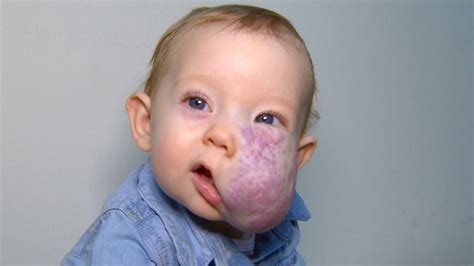 See 2-Year-Old's Incredible Transformation After Surgery To Remove ...