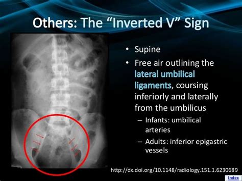 Cupola Sign X Ray - HOYOGG