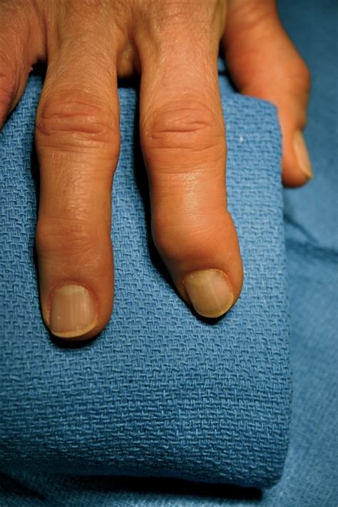 fingertip arthritis - DIP joint | Swelling and deformity of … | Flickr