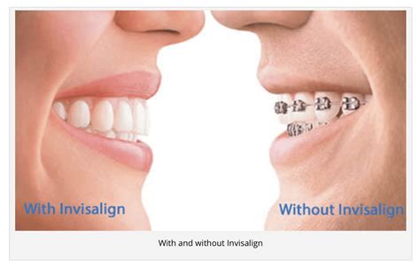 Get Your Invisalign Clear Braces at Our Ideal Smile Philadelphia Specialist