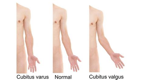 Cubitus Valgus: Causes, Symptoms, Treatment, Prevention, & More - Healthroid