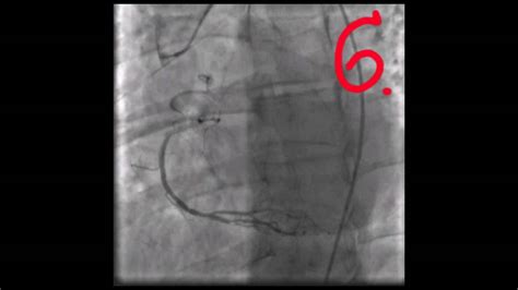 Coronary stent procedure in treatment acute miocardial infarction - YouTube