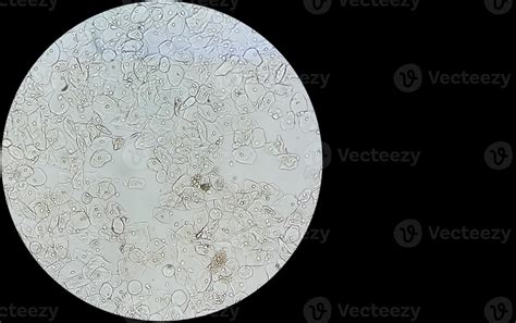 Photomicrographic close view of Abnormal urine analysis with copy space ...