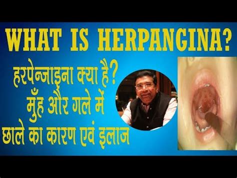 Herpangina, It's Causes, Symptoms and Treatment - YouTube