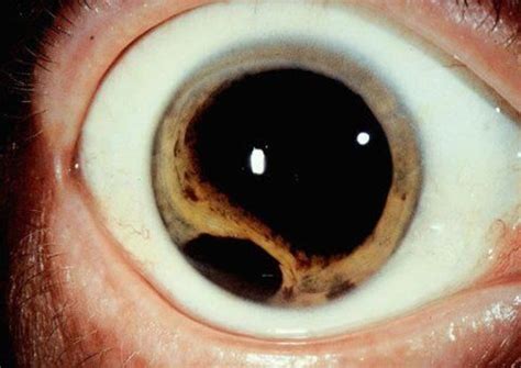 double pupil | ⦿⦿ Uvea: Iris, Ciliary Body and Choroid ⦿⦿ | Pinterest