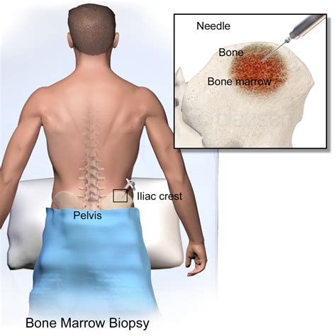 How Painful is a Bone Marrow Biopsy? Can You Be Sedated?