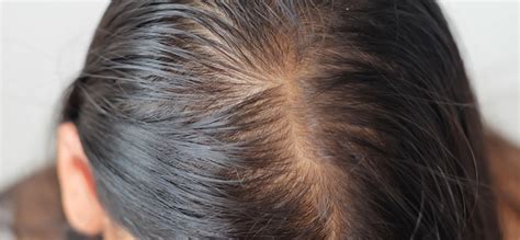 Female Pattern Baldness - Causes & Treatments