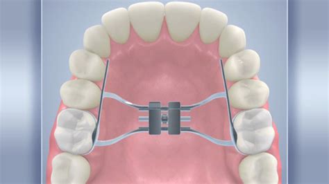 Palatal Expander best Solution at Rehan Dental Surgery | Free Consultation