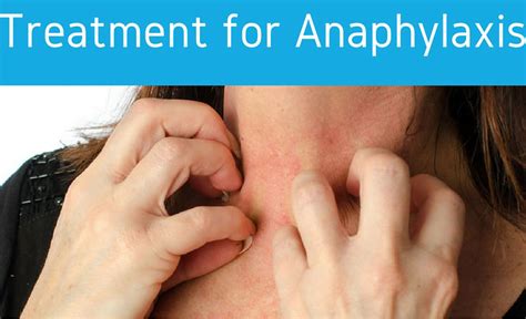 Anaphylaxis - Signs and Symptoms, Anaphylaxis Treatment