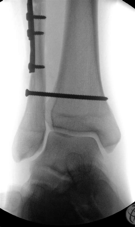 Ankle fracture - wikidoc