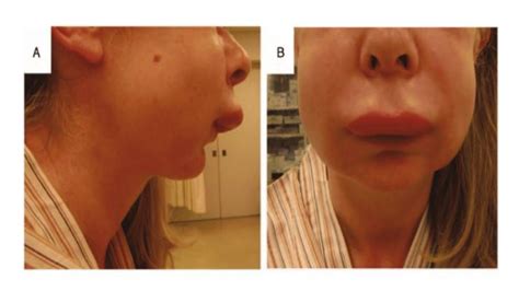 Monitor for hereditary angioedema triggers | Vinmec