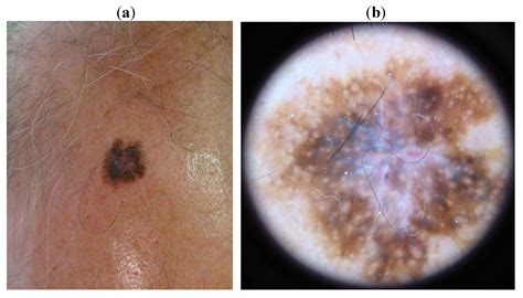 Melanoma Scalp