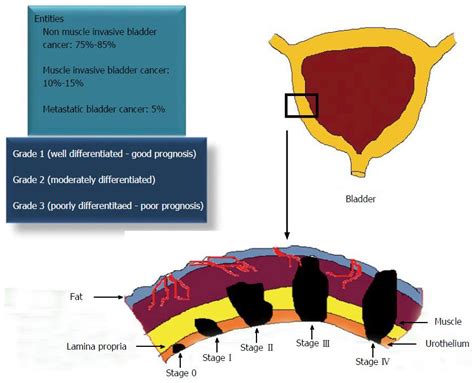 Epithelial plasticity in urothelial carcinoma: Current advancements and future challenges