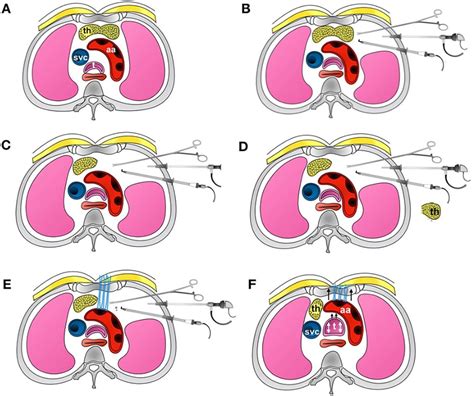 Figure 3 from Thoracoscopic aortopexy for symptomatic tracheobronchomalacia. | Semantic Scholar