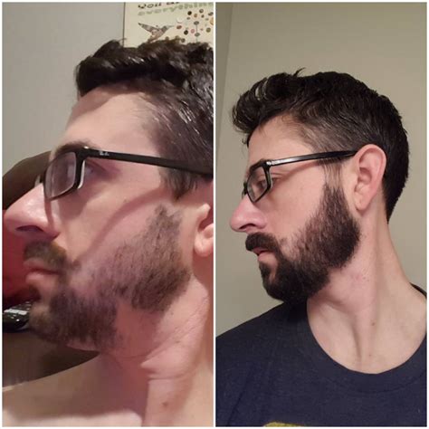 Patchy Beard success stories Before and After photos - Page 23 - Beard Board