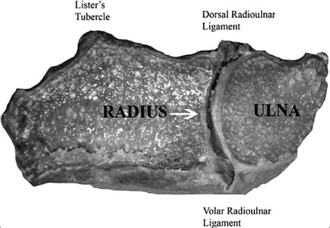 Transverse section through the DRUJ in a cadaver, showing the sigmoid... | Download Scientific ...