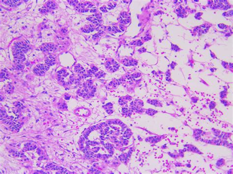 Human gastrointestinal Carcinoid tumor H&E 10x | Tissue types, Lawn and ...