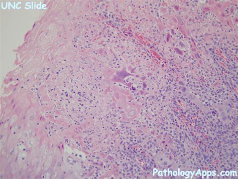 hsv pathology