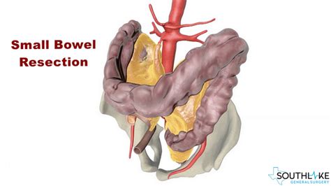 Small Bowel Problem-Diagnosis, Symptoms, Treatmnent and Risk Factors