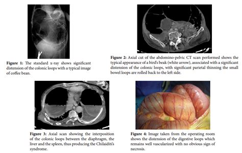 A Very rare case of synchronous volvulus of the transverse colon and ...