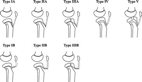 Tibial tubercle fractures in children with intra-articular involvement: surgical tips for ...