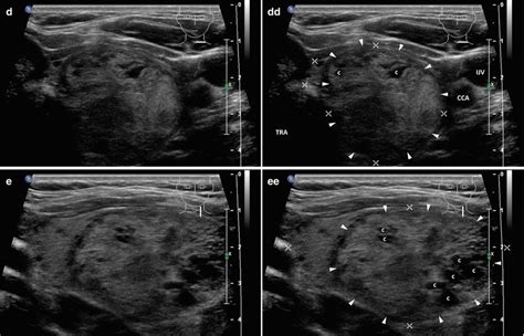 Multinodular Goiter | Radiology Key