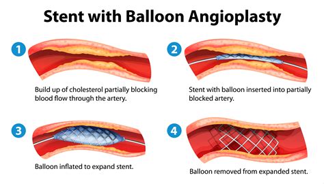 escanear Campo Polar blocked artery in heart stent Lima trolebús arcilla