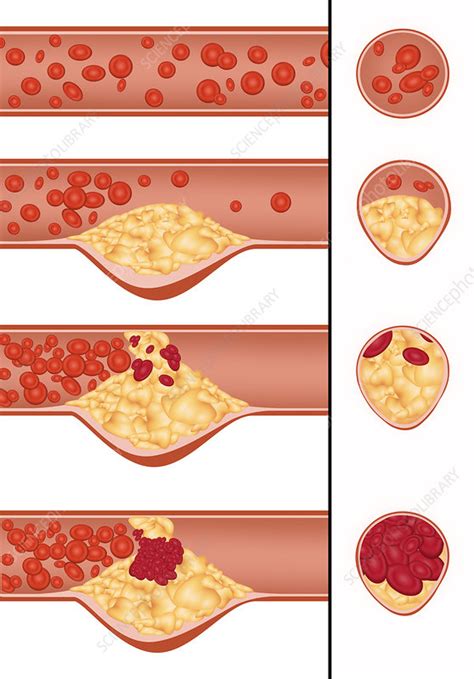 Plaque in Artery, Illustration - Stock Image - F031/7217 - Science Photo Library