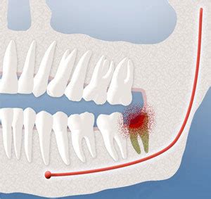 Post Extraction of Wisdom Teeth Las Vegas | Dry Socket, Infection