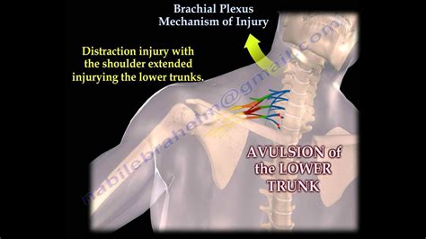 Brachial Plexus Injury Symptoms