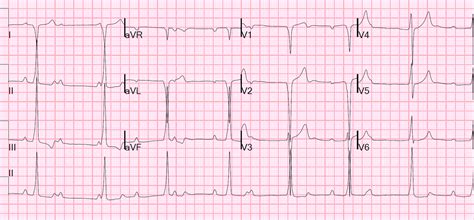 Dr. Smith's ECG Blog: Cold symptoms and bradycardia. What is this pre ...