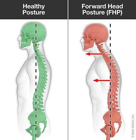 Forward Head Posture | Chiropractor In Tampa, FL | Dr. George Kollias