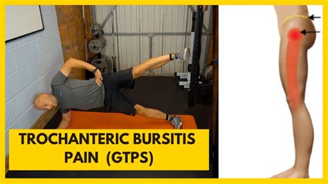 Trochanteric Bursitis Pain (Best Exercises) - YouTube