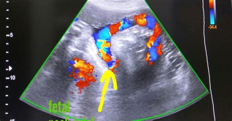 Ultrasound imaging: Nuchal cord