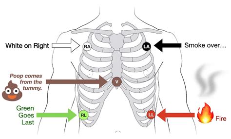 12 Lead Ecg Placement Mnemonic